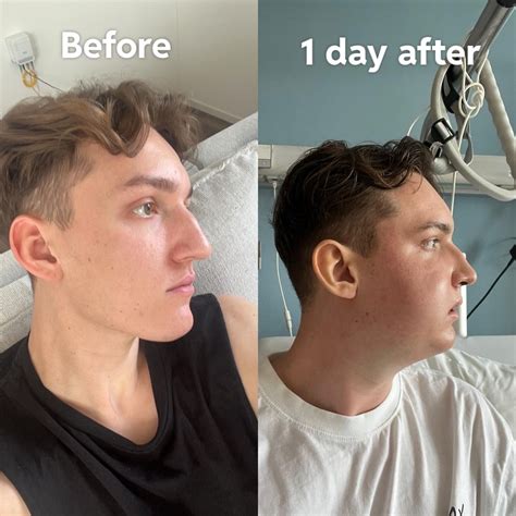 reddit jaw surgery